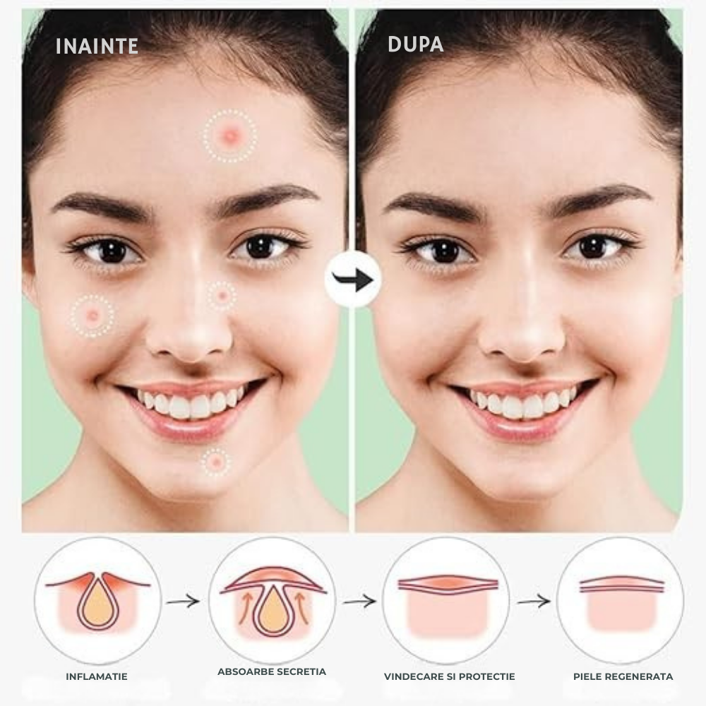 Plasturi pentru Cosuri cu Hidrocoloid de Inalta Calitate Wanty® Formula Hipoalergenica cu Retinol-Acetat si Acid Salicilic, Fara Parabeni, Set 72 bucati Wanty