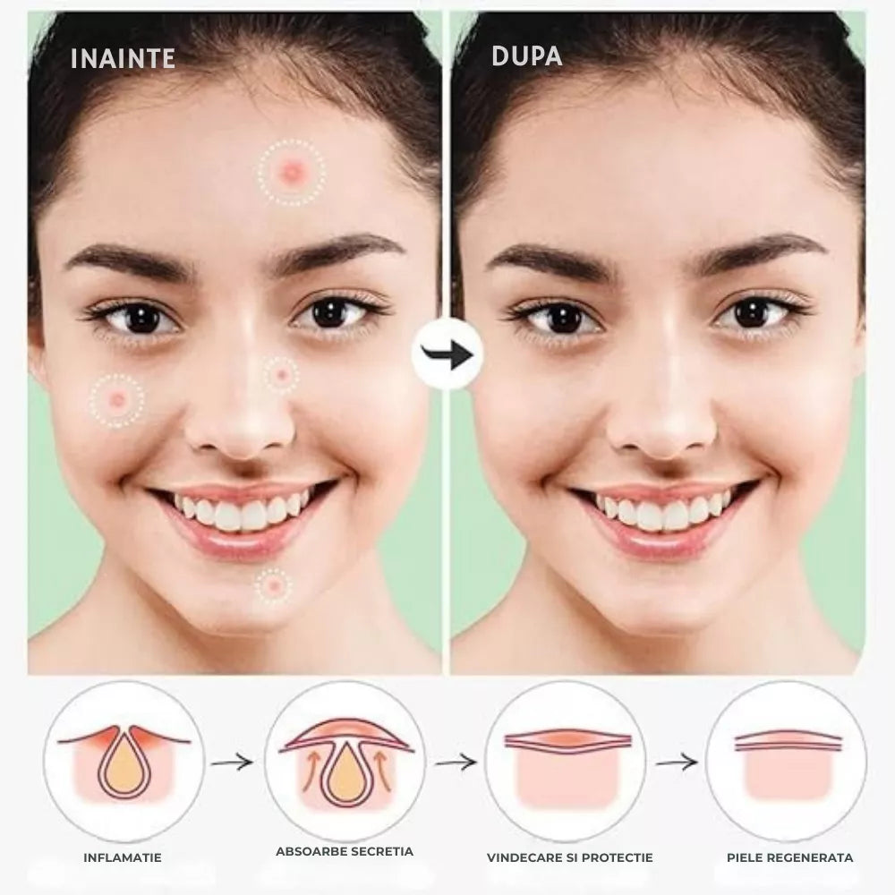 plasturi acnee pentru vindecare rapida si protectie a pielii
