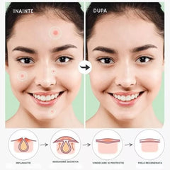 plasturi acnee pentru vindecare rapida si protectie a pielii