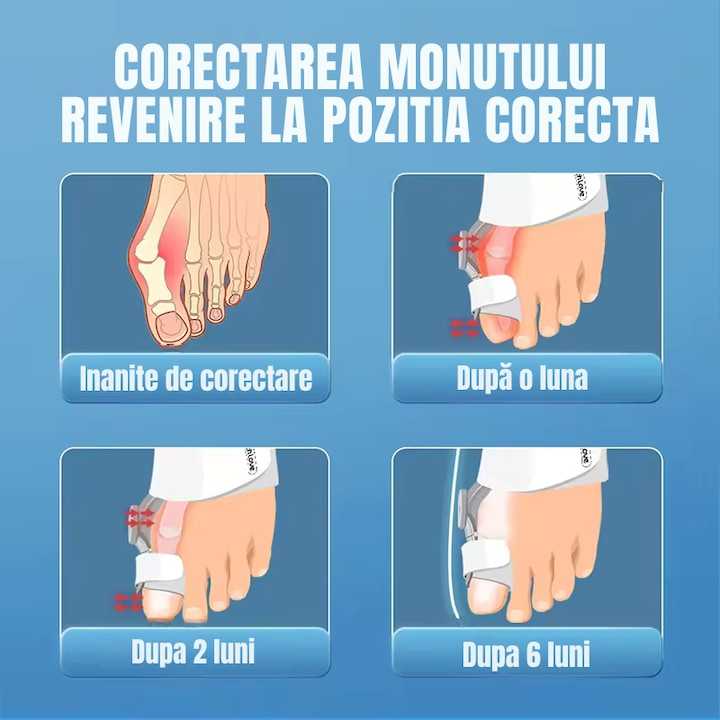 Corector monturi - Repozitionare si Corectare Deget Wanty